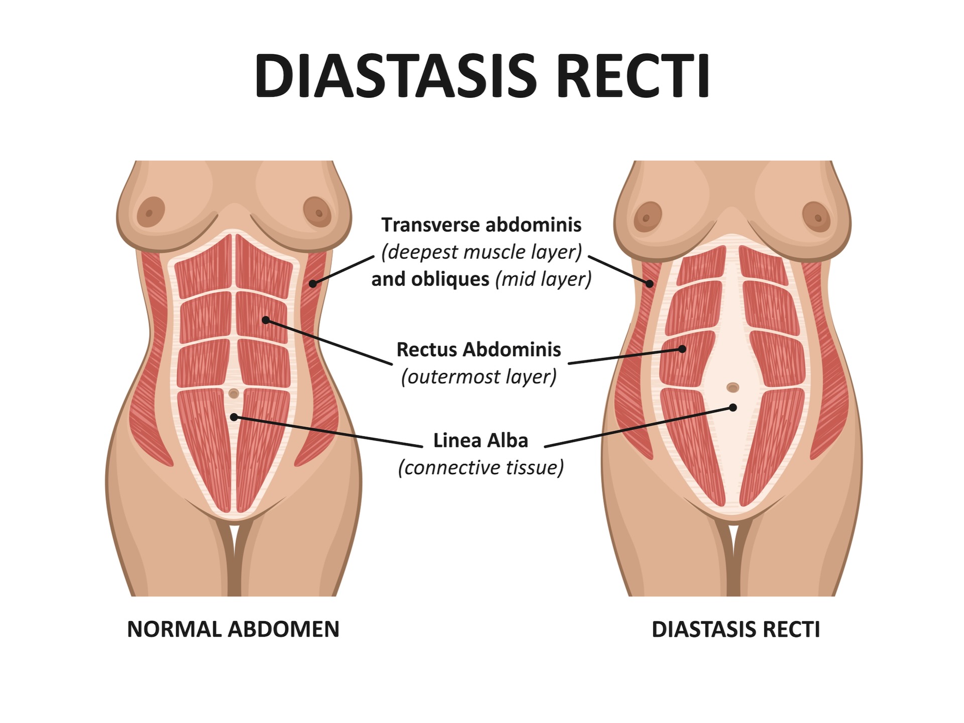 Diastasis Rectus Abdominis: Symptoms & Treatment - Lesson